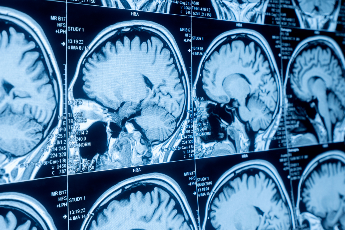 Can the biological age of your brain predict how long you’ll live?